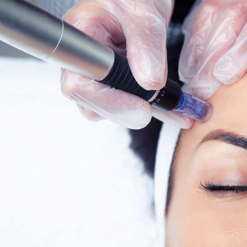 Morpheus8 treatment Woodham Ferrers from Lipo Sculpt - Book in today!