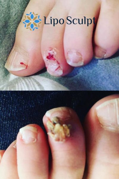 Wart removal customer results from Lipo Sculpt Woodham Ferrers